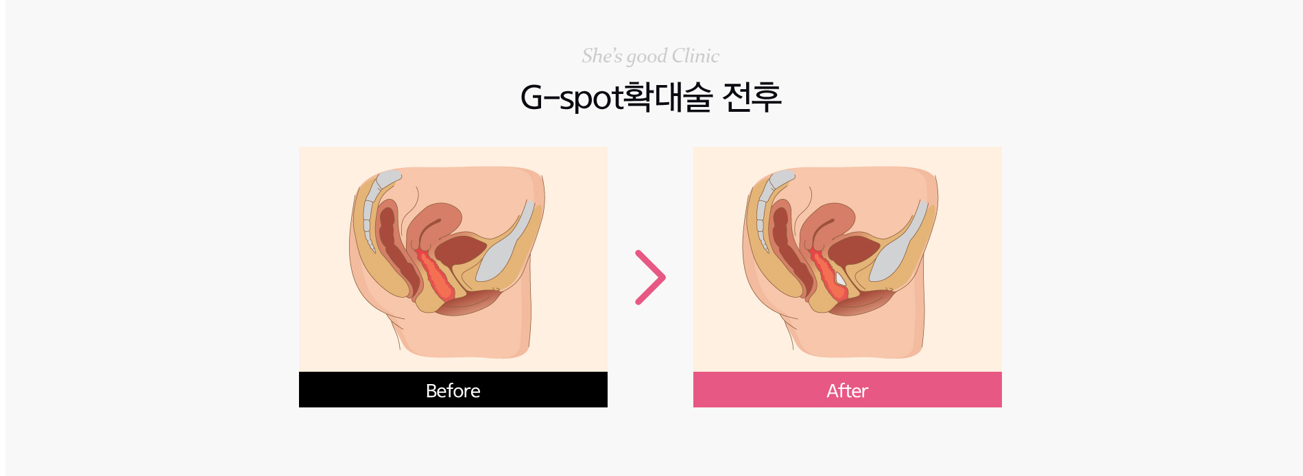 음핵노출증